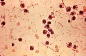 Заболевания вызванные бактериями у человека 12